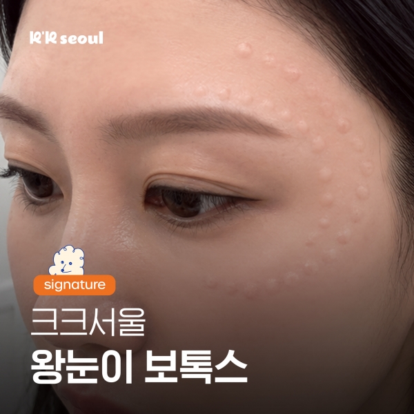 크크서울 왕눈이보톡스, 눈매 또렷해지는 이유